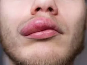 آنژیوادم