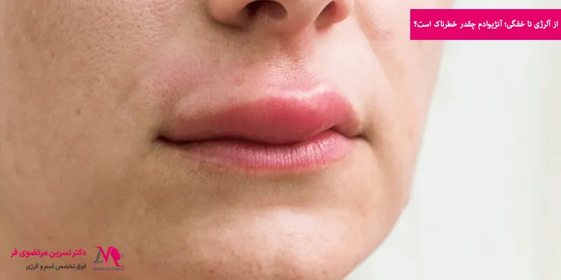 از آلرژی تا خفگی؛ آنژیوادم چقدر خطرناک است؟