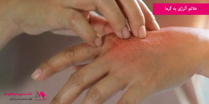 علائم آلرژی به گرما