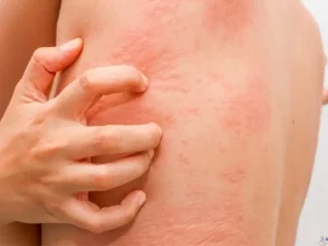 آلرژی به بادام زمینی چه علائمی دارد؟