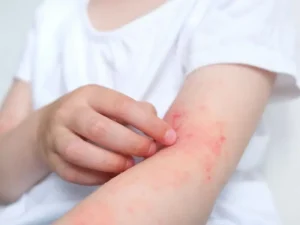 آلرژی به مواد شیمیایی چیست