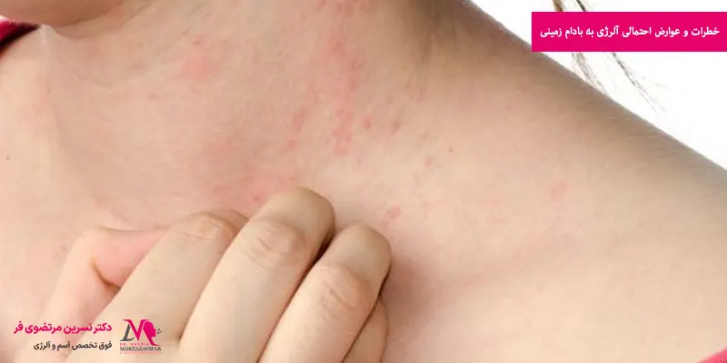 خطرات و عوارض احتمالی آلرژی به بادام زمینی