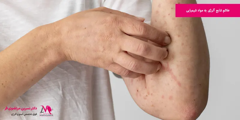 علائم شایع آلرژی به مواد شیمیایی
