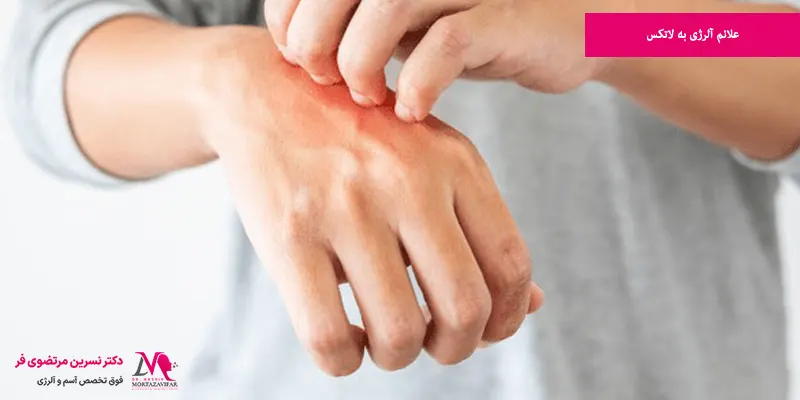 علائم آلرژی به لاتکس