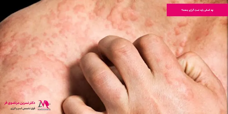 چه کسانی باید تست آلرژی بدهند؟