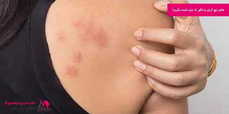 علائم رایج آلرژی به انگور که نباید نادیده بگیرید!